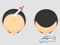 عکس وکتوری سر برای کاشت مو